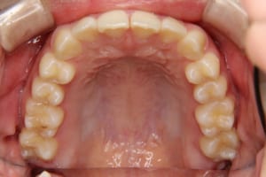 特に中切歯が口蓋側転位しています